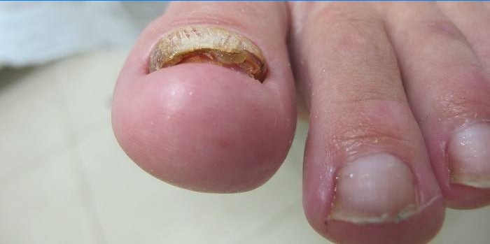 Berørt toenail