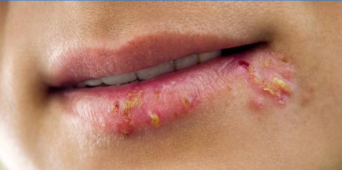 Cryomassage er kontraindiceret i herpes