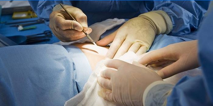 Klassisk abdominoplastik i maven