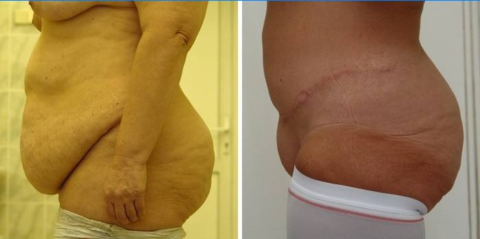 Abdominoplastik Resultat