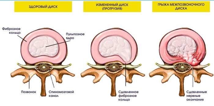 Fremspring og brok i den intervertebrale disk