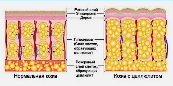 Hvad er cellulite?