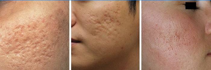 Acne Ar