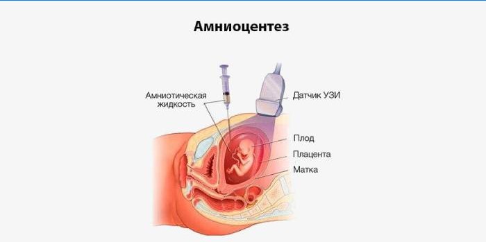 Amniocentesis om ordningen