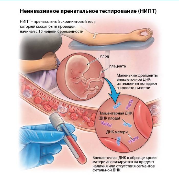 Ikke-invasiv prenatal test (NIPT)