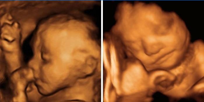 Ultralydscanning af en dreng og en pige ved 25 ugers drægtighed