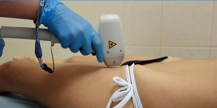 Laser depilation af bikinizonen
