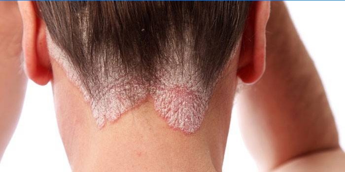 Psoriasis i hovedbunden