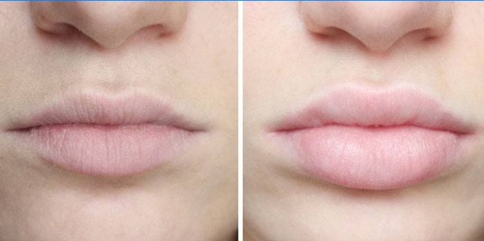 Hyaluronsyre på læberne før og efter