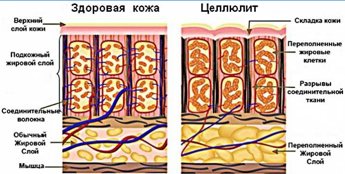 Cellulite om ordningen