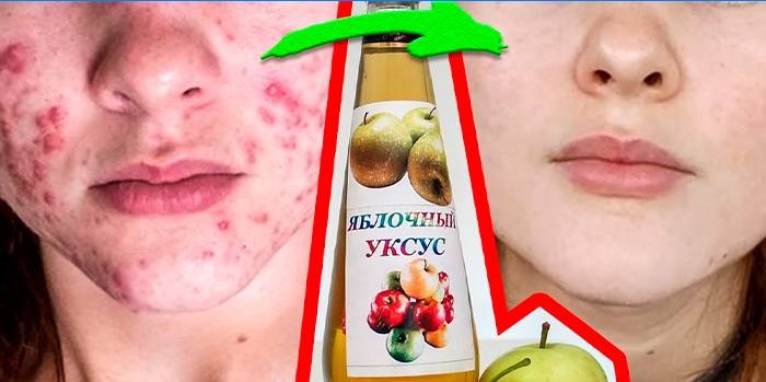 Apple cider eddike acne