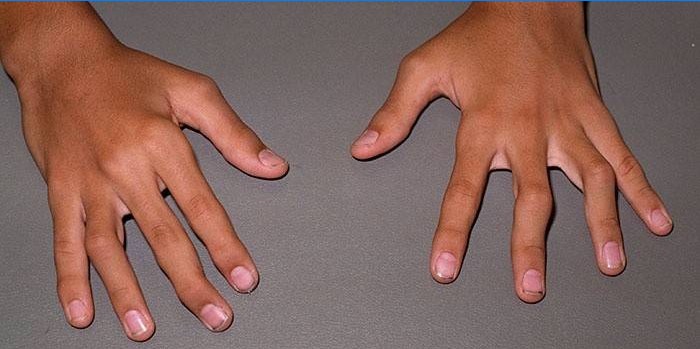 Gigt i fingrene