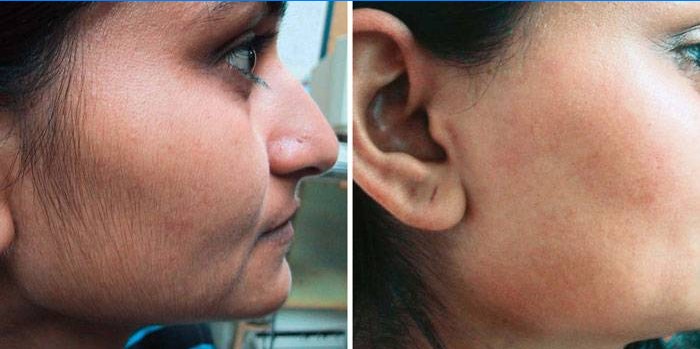 Laserhårfjerning i ansigtet: før og efter fotos